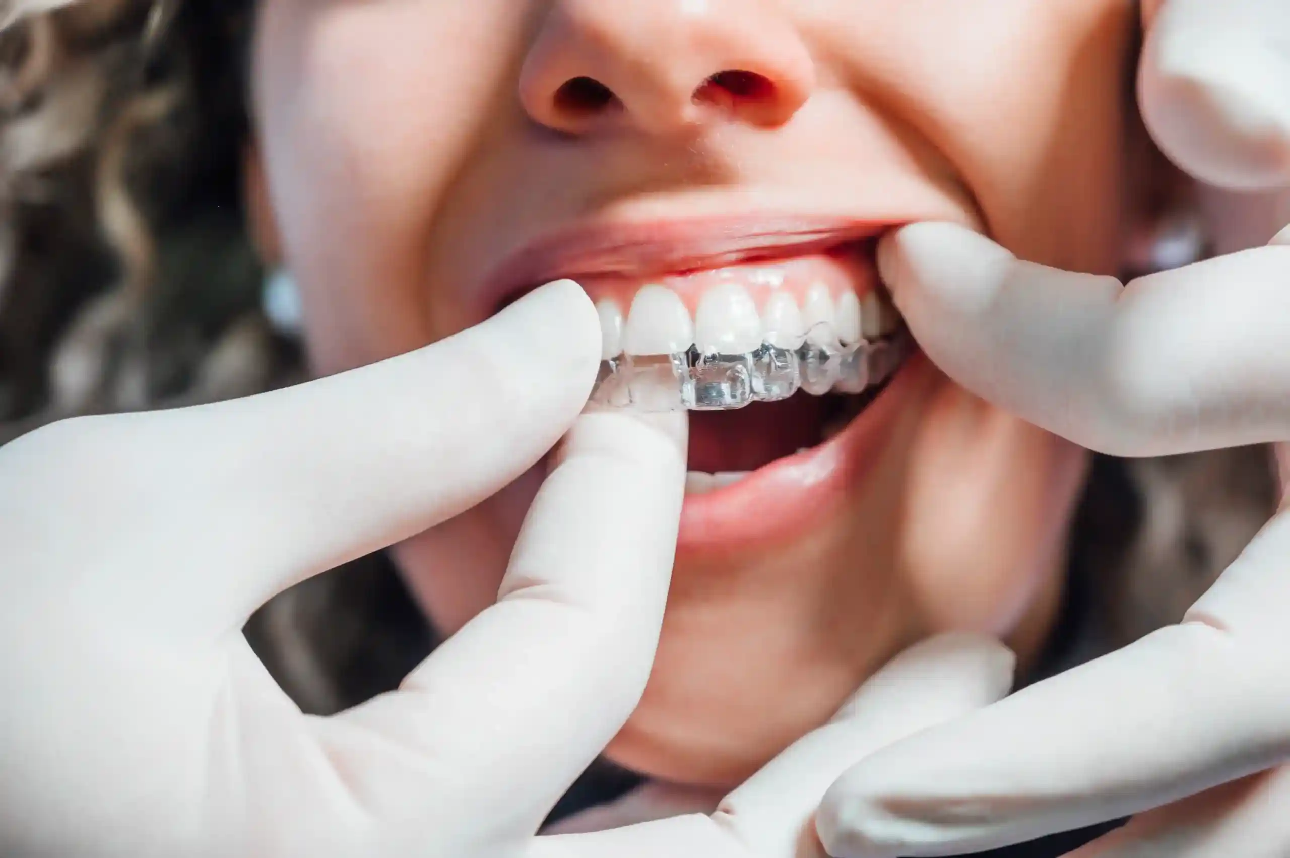 Teeth straightening treatment showing aligned smile with orthodontic correction results