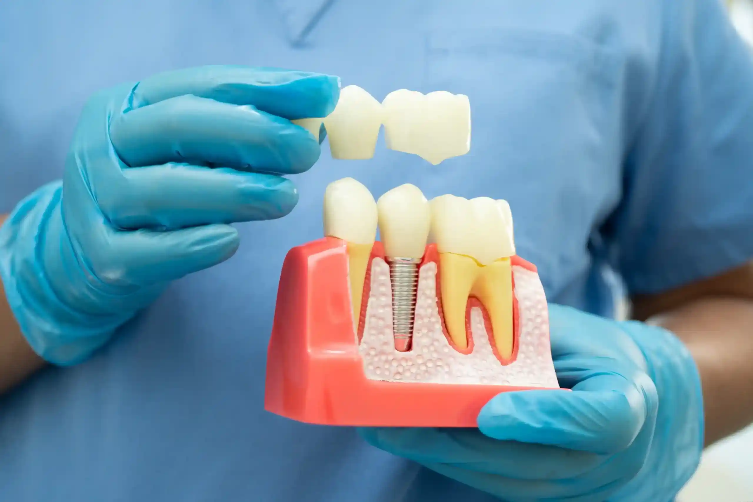 A person in blue gloves holding a dental model that shows a silver implant screw in the gums, with a white dental bridge being placed over the teeth.
