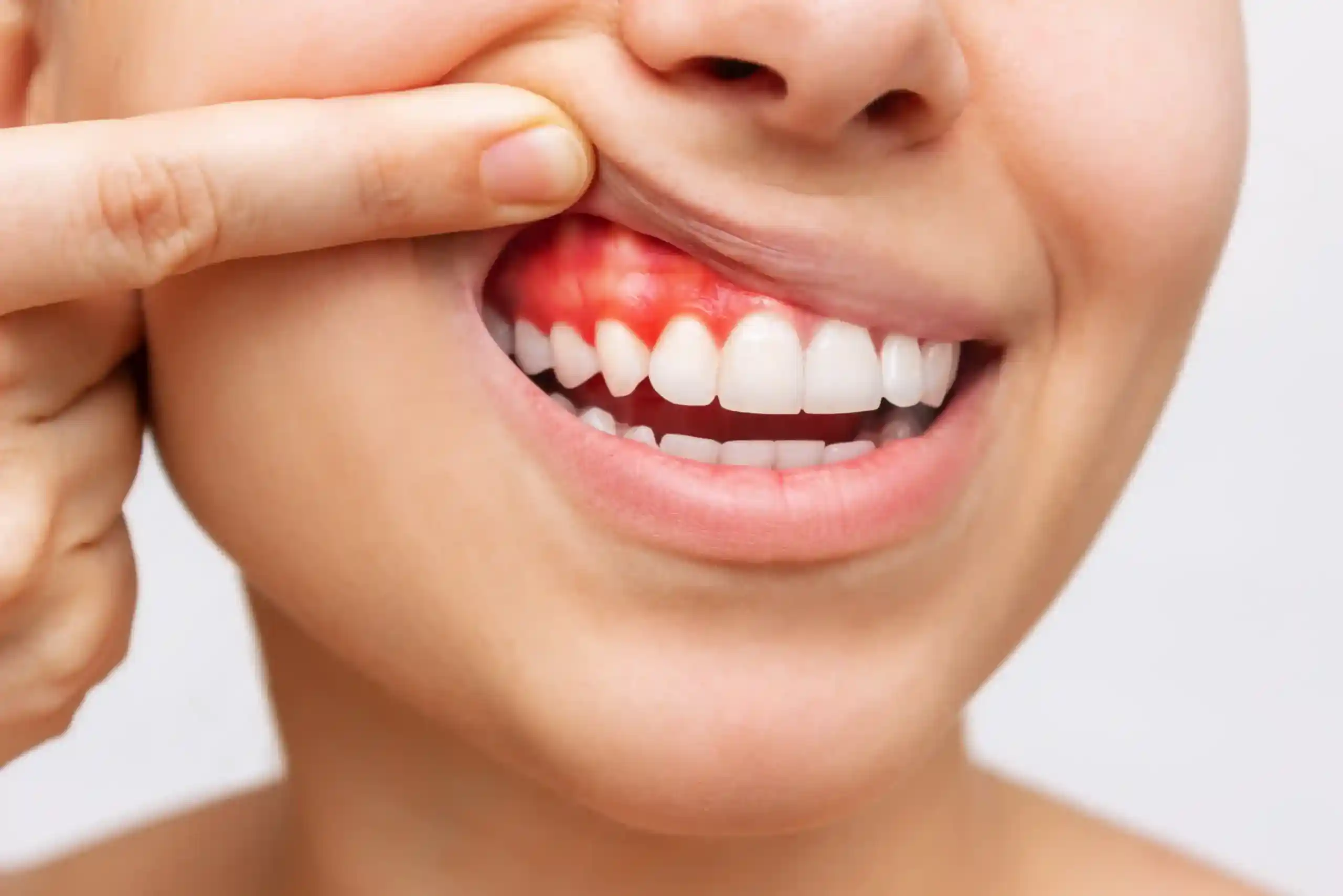 A close-up of a person lifting their upper lip to reveal red, inflamed gums and visible gum recession above the teeth.