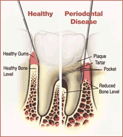 Healthy vs periodontal disease diagram